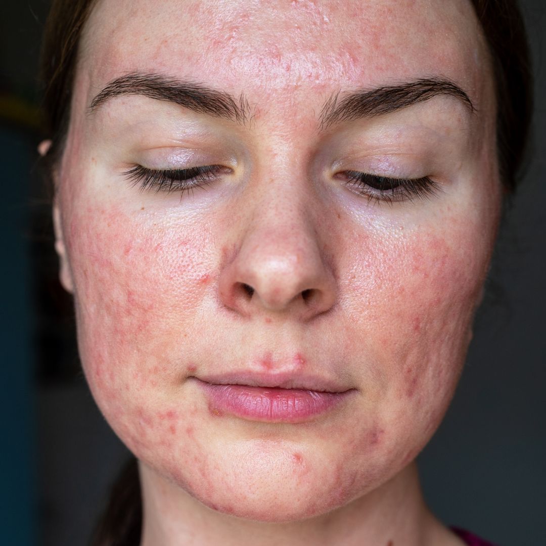 Couperose e Rosacea