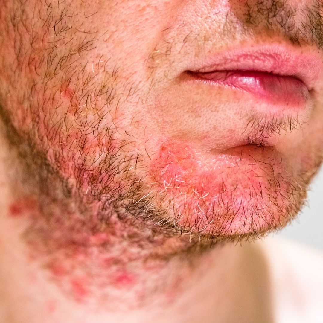 Dermatite atopica (eczema)