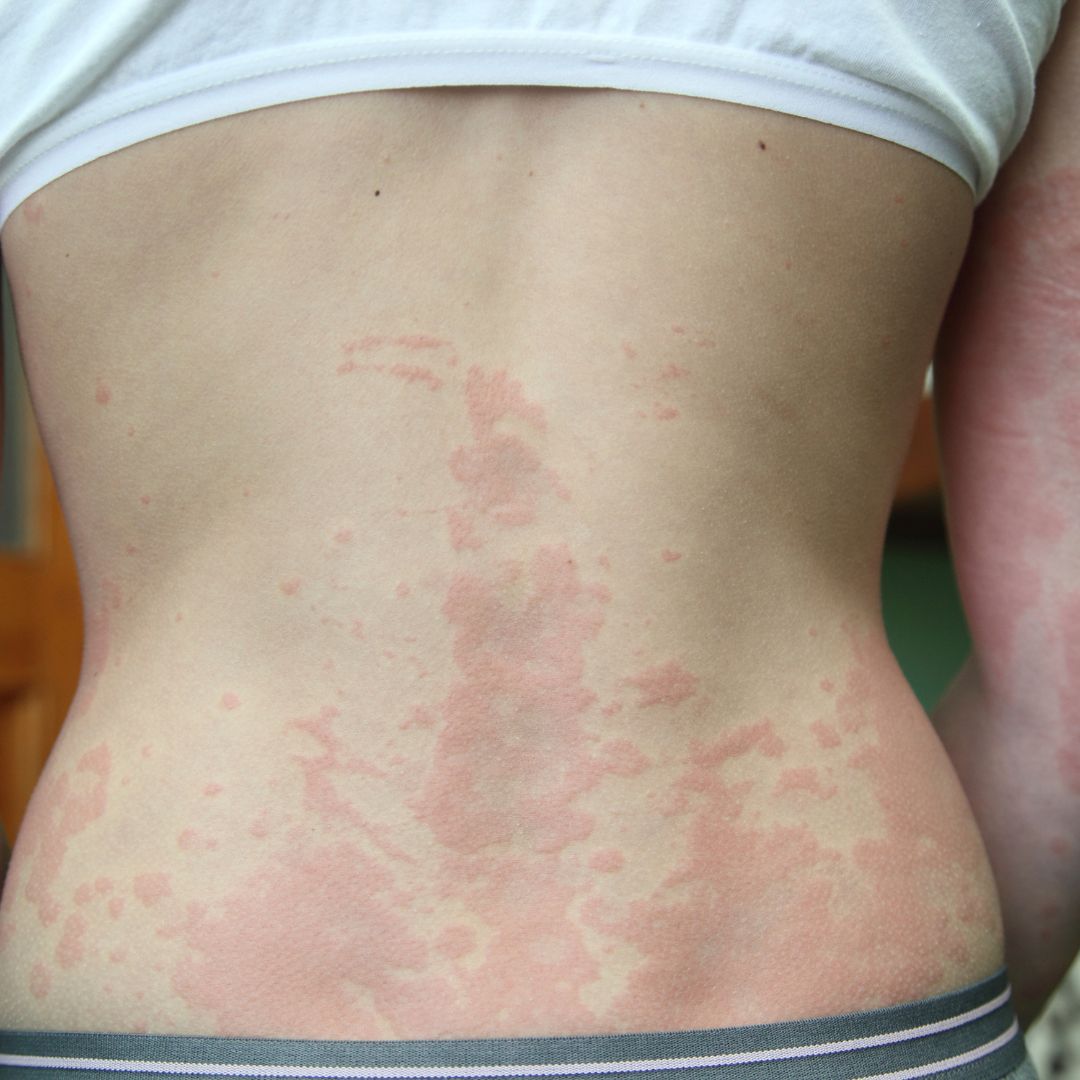 Dermatite da contatto (irritativa o allergica)