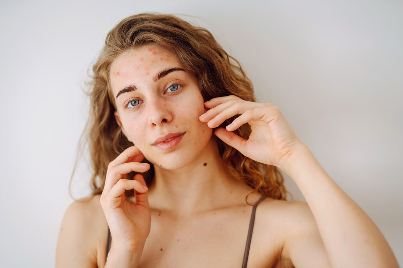 portrait-of-beautiful-young-woman-with-inflammatio-2024-10-02-23-24-43-utc_-_dimensioni_grandi.jpg